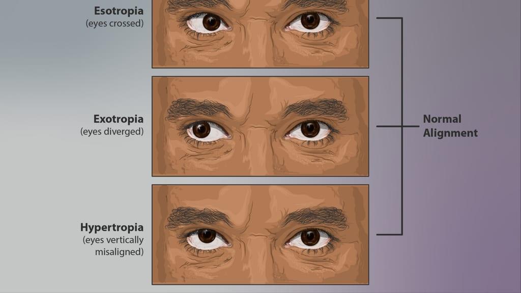 New AI tool accurately identifies strabismus from nine photographs